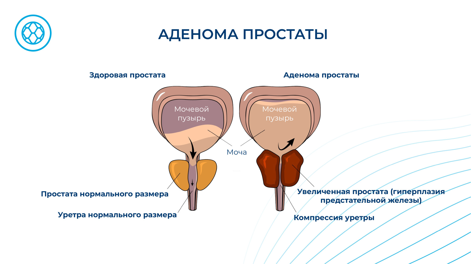 Лечение Аденомы простаты