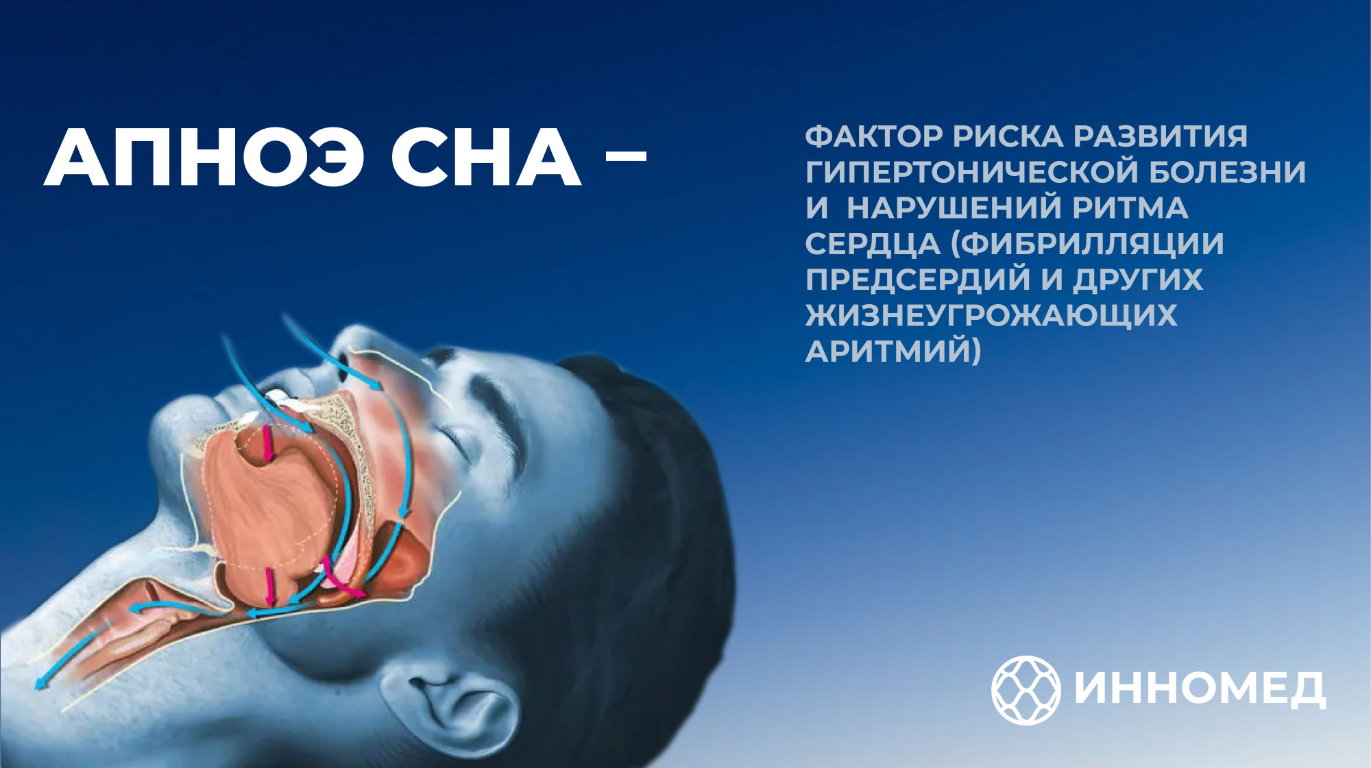 Не думай о храпящих свысока: что такое апноэ сна