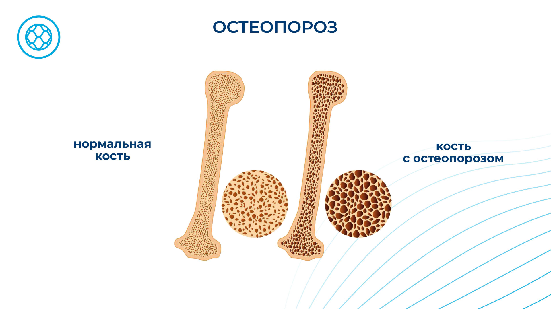 Остеопороз