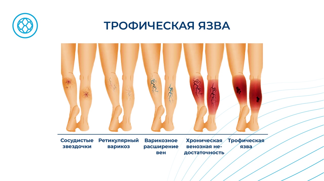 Лечение трофических язв
