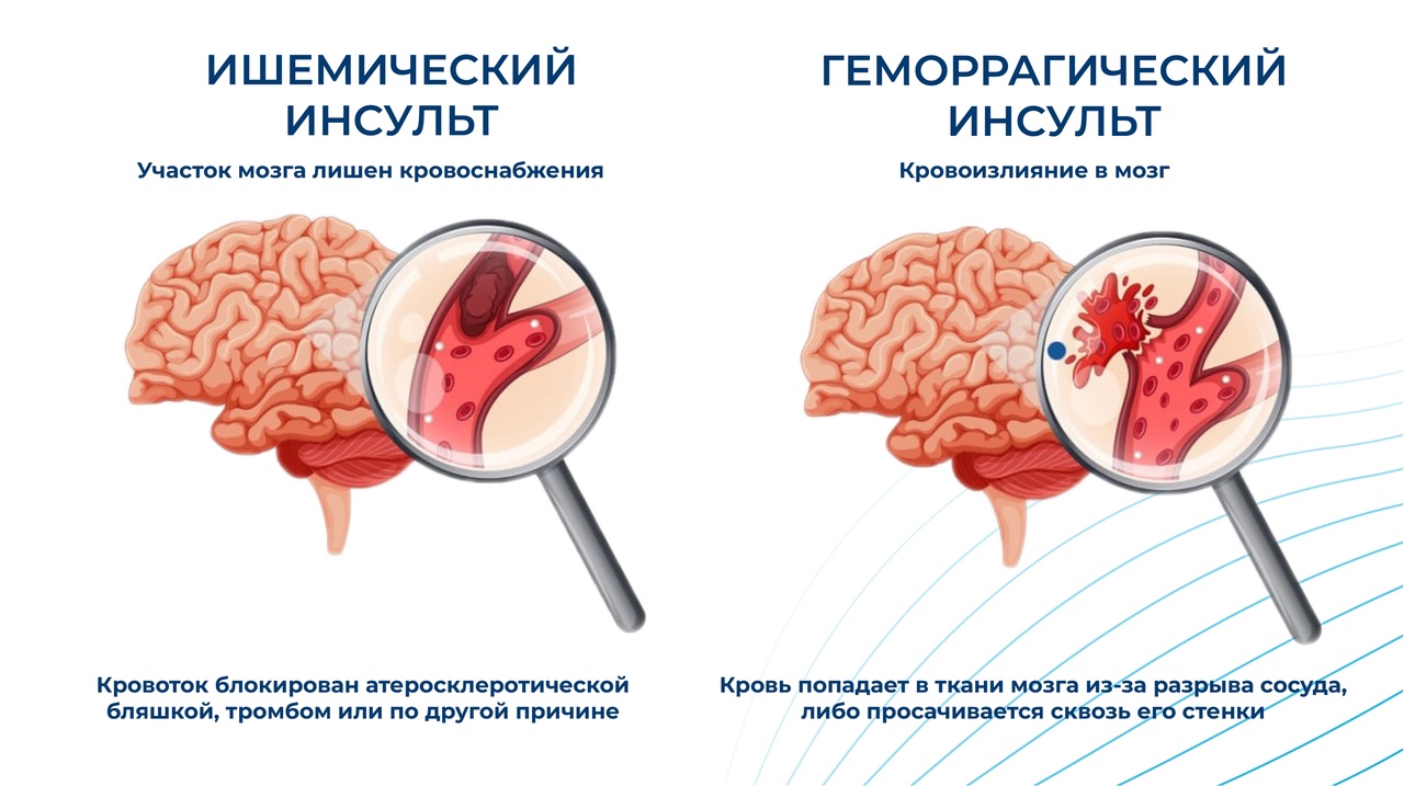 Предупредить инсульт сложно, но можно