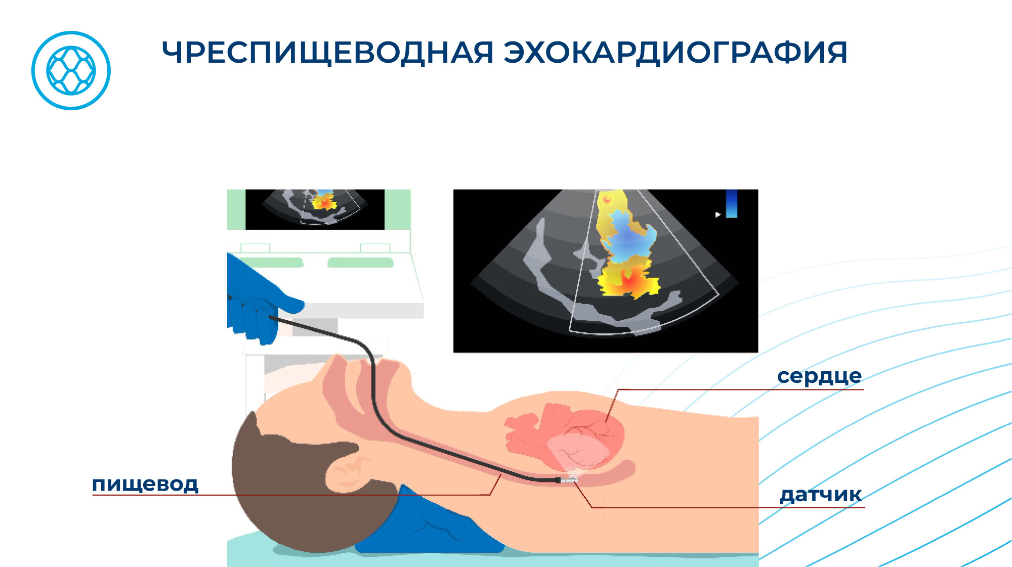 Чреспищеводная эхокардиография: как найти путь к сердцу пациента